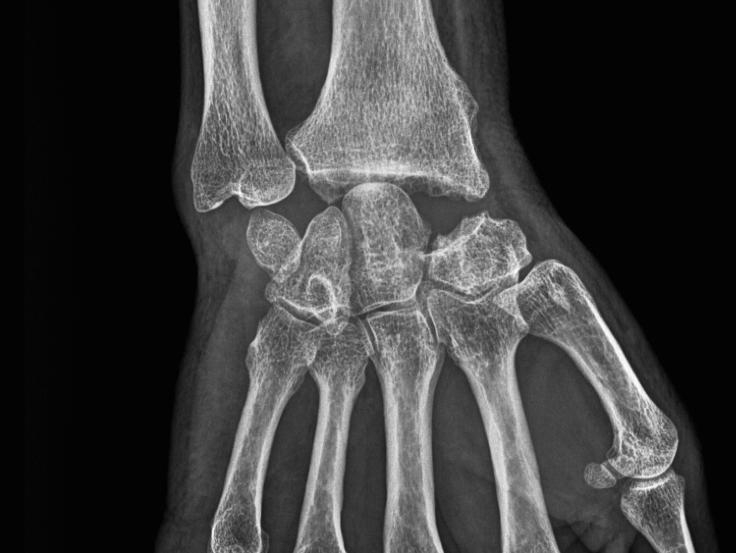 Arthrose du poignet - Clinique Ostéo Articulaire des Cèdres - Grenoble